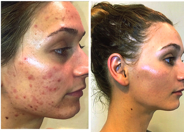 Before and After